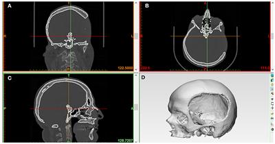 Design and Additive Manufacturing of a Biomimetic Customized Cranial Implant Based on Voronoi Diagram